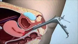 Pap Test  - Procedure