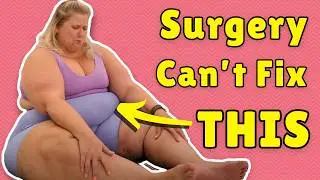 600 lbs ‘Because of Genetics’ – Latest Excuses (and Delusions) from Anna