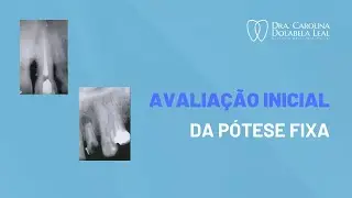 Avaliação inicial de um prótese fixa