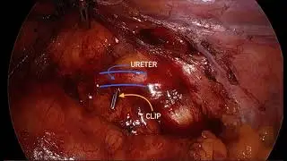 A simple and non-invasive method to re-identify the ureter during laparoscopic colorectal surgery