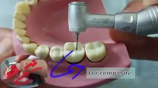 شرح تفصيلى خطوه بخطوه class 1 cavity preparation والأخطاء اللى ممكن تحصل وازاى نحلها