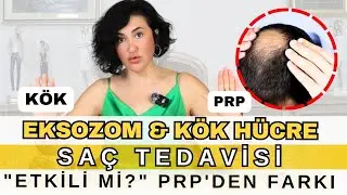EKSOZOM, KÖK HÜCRE SAÇ TEDAVİSİ! ETKİLİ Mİ? PRP'DEN FARKI NEDİR?