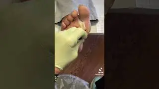 Blister Removal