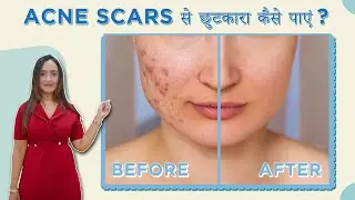 Acne Scars :Types, Causes & How To Treat Them | Acne Scars से छुटकारा कैसे पाएं?| Dr Priyanka Ghatge
