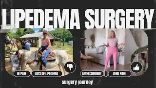 Lipedema surgery