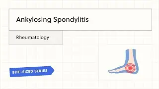 Ankylosing Spondylitis