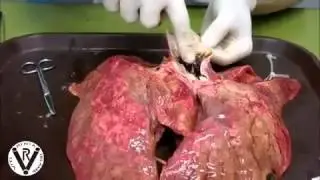 L'état de nos poumons après avoir fumer