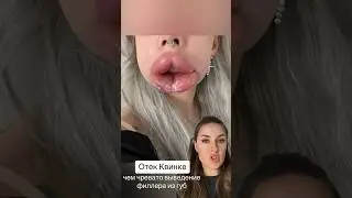 How did the lip filler removal end up? 