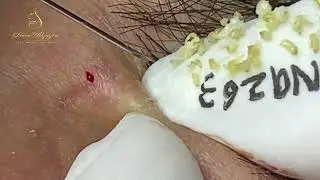 Blackhead and Pimple Extraction Before and After