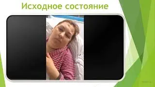 Нормотензивная гидроцефалия