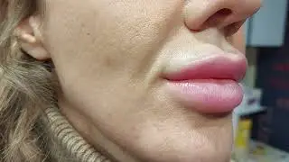 Когда запрос: убрать усы(гиалуроновые) ,оставив основной объем.