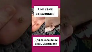 БОРОДАВКИ ОТВАЛИЛИСЬ! #бородавки #пятка #пяточнаябородавка #корень #сибирскоездоровье #мозоль