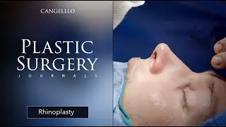 How Are Rhinoplasties Done? | Plastic Surgery Journals | Rhinoplasty | Cangello Plastic Surgery