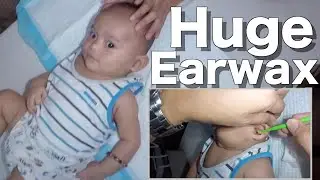 Removing Boy's Huge Earwax | It's Small but Terrible!