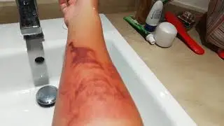 Последствия тату хной...