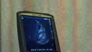 Gallstone Ultrasound