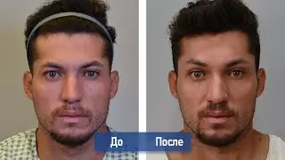 Подтяжка лба и мини-фейс лифтинг - для мужчин