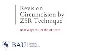 ZSR Revision Circumcision operative video / Best way to Get rid of ugly scars