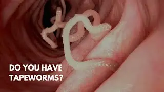 How to SURVIVE TAPEWORMS (viewer discretion is advised)
