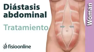 ¿Que es una diástasis? Valoración y tratamiento