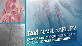 TAVI NASIL YAPILIR? | Kalp Kapağı Ameliyatsız Nasıl Değiştirilir?