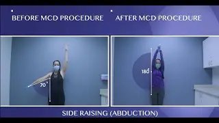 Patient's Frozen Shoulder Cured!