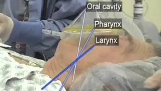 Intubation OraoTracheal NEJM