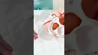 Родовая травма у новорожденного