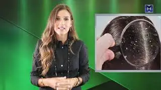 UpLift | How to get rid of Dandruff - القشرة