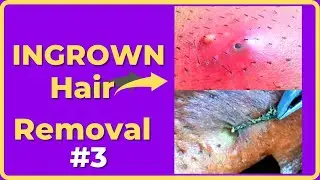 Ingrown hair removal videos [Compilations #3]  #ingrownhair #Compilations