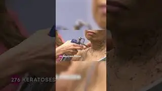 Woman Withstands INTENSE PAIN To Freeze A Record Number Of Keratoses! 
