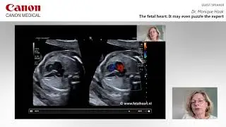 ISUOG 2020 Monique Haak - The Fetal Heart: It may even puzzle the expert