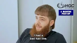 Dylan’s Hair Transplant Story | From Hiding Under Hats to Full Confidence