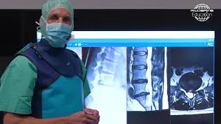 Prof. Dr. Christoph Siepe - Full-endoscopic discectomy at the lumbar spine.