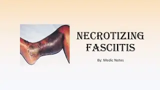 Necrotizing fasciitis - risk factors, signs and symptoms, investigation, treatment, prognosis