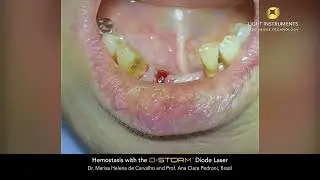 Hemostasis with the D-Storm™ Diode Laser