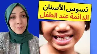 علاج تسوس الاسنان الدائمة عند الطفل
