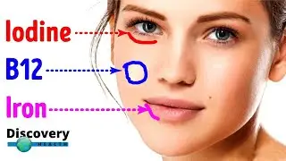 5 Vitamin deficiencies that show up in your Face | Discovery health