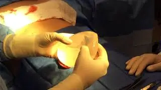En bloc Explant from under the muscle