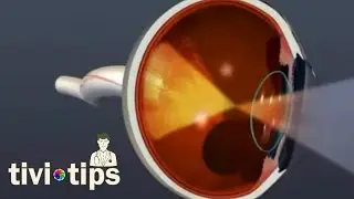 Katarakt ameliyatından sonra gözlük kullanmak gerekli midir?
