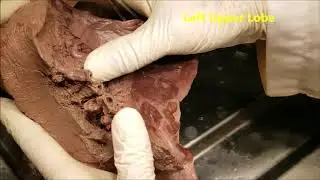 LUNG HILUM Bronchial Tree and Pulmonary Vessels Demonstration – Sanjoy Sanyal