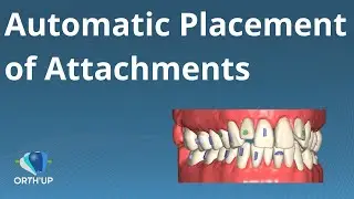 Automatic Placement of Attachments | ORTH'UP CAD software