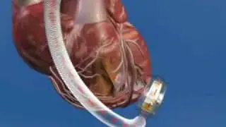 HeartWare HVAD Left ventricular Assist Device