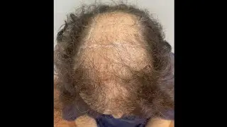 Operación DR. LOZA paciente DESCONTENTO en España 🇪🇸😥