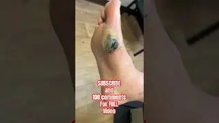 Huge Callus that needs shaved!