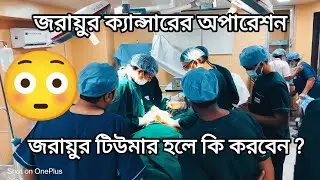 জরায়ুর টিউমার || জরায়ুর ক্যান্সার হলে কি করবেন ?