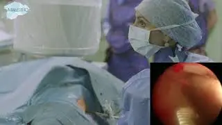 Nephroscopy and combined lithotripsy