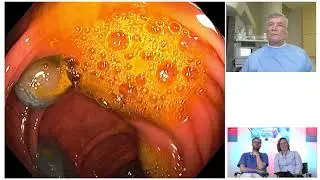 EMR of a colon polyp