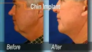 Plastic Surgery Chin Augmentation