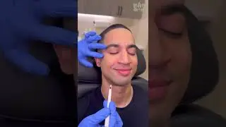Botox for Men